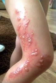 Skin blistering caused by giant hogweed. Image credit: Cosima Pferdeliebe, Wikimedia Commons