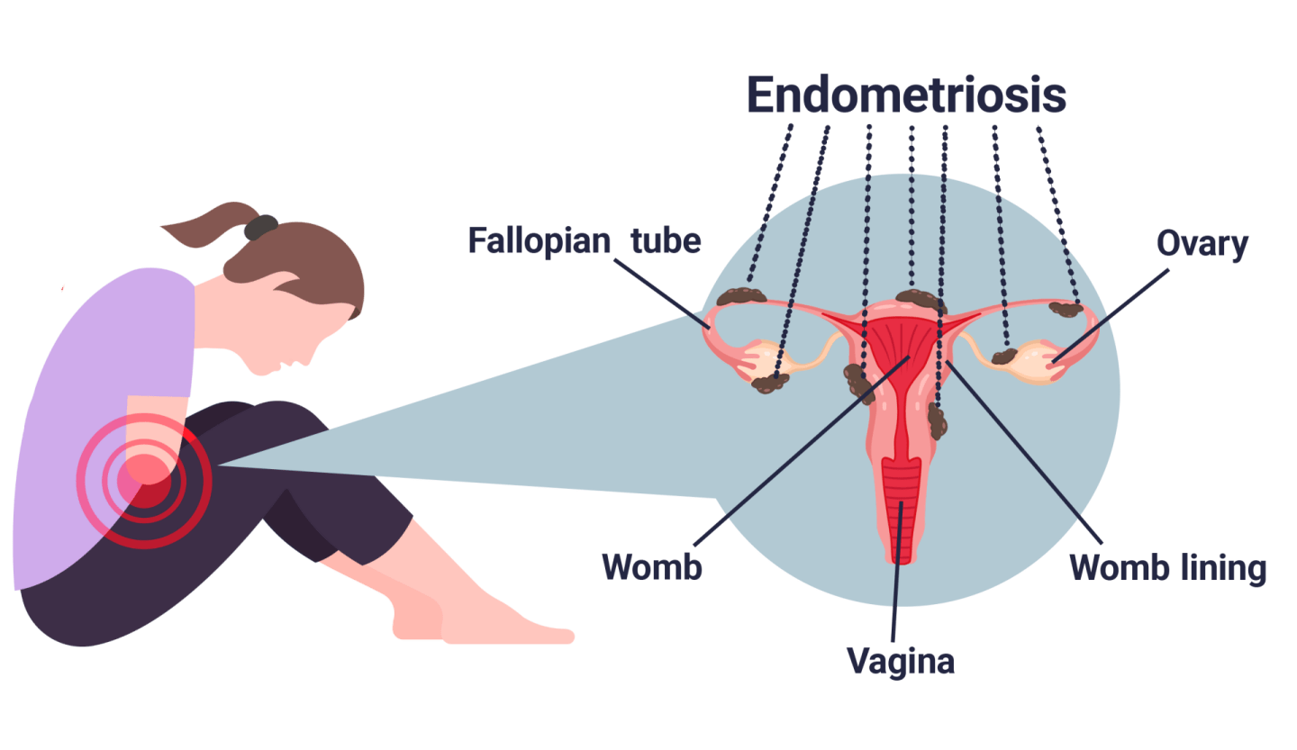Endometriosis-diagram (1)